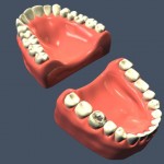 3D打印牙齿